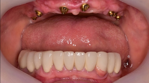 Dental Implant Pegs