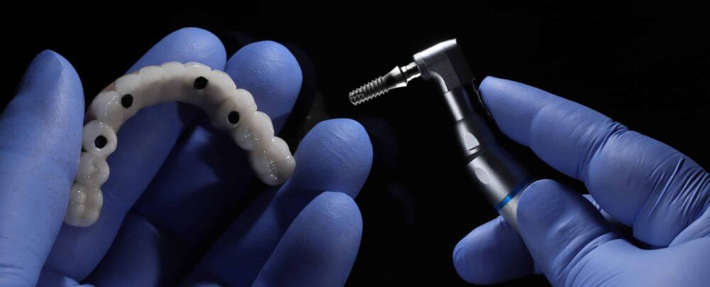 All-on-X implants vs. traditional dentures Omaha