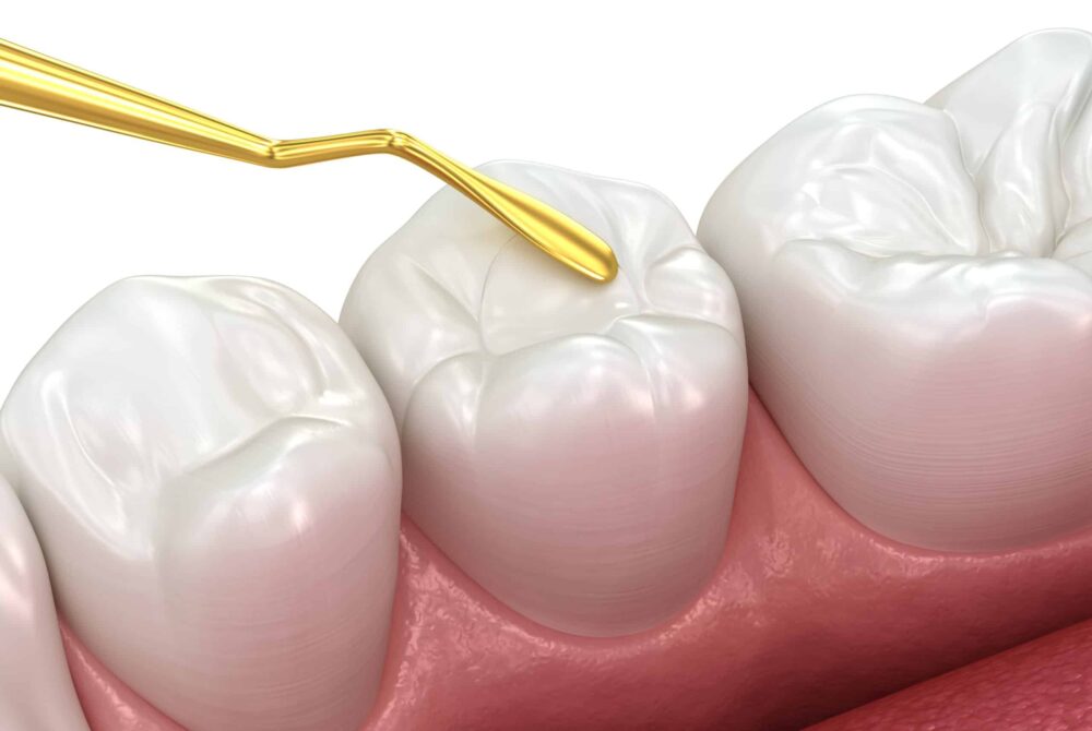 dental fillings omaha
