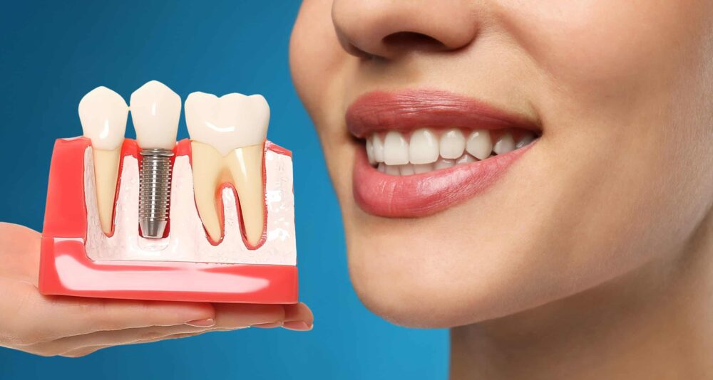 dental implants near me
