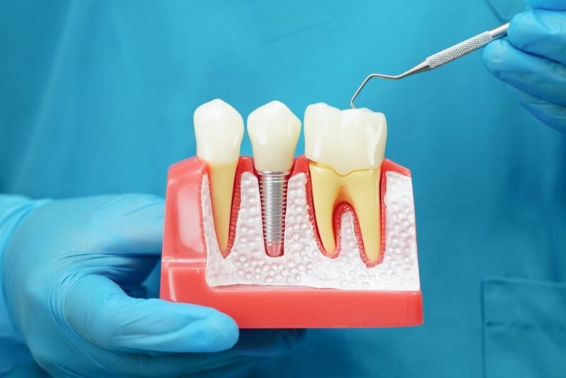 does a dental implant hurt