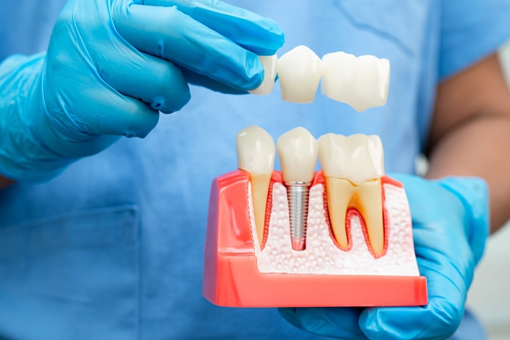 dental implants omaha